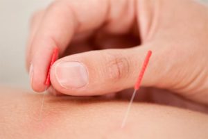 Acupuncture