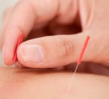 Acupuncturist inserting needle